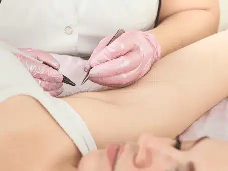 an electrolysis conducting underarm hair removal for a woman